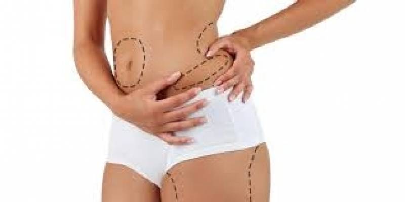 Dermato Funcional Abdominoplastia Paineiras do Morumbi - Dermato Funcional de Gordura Localizada