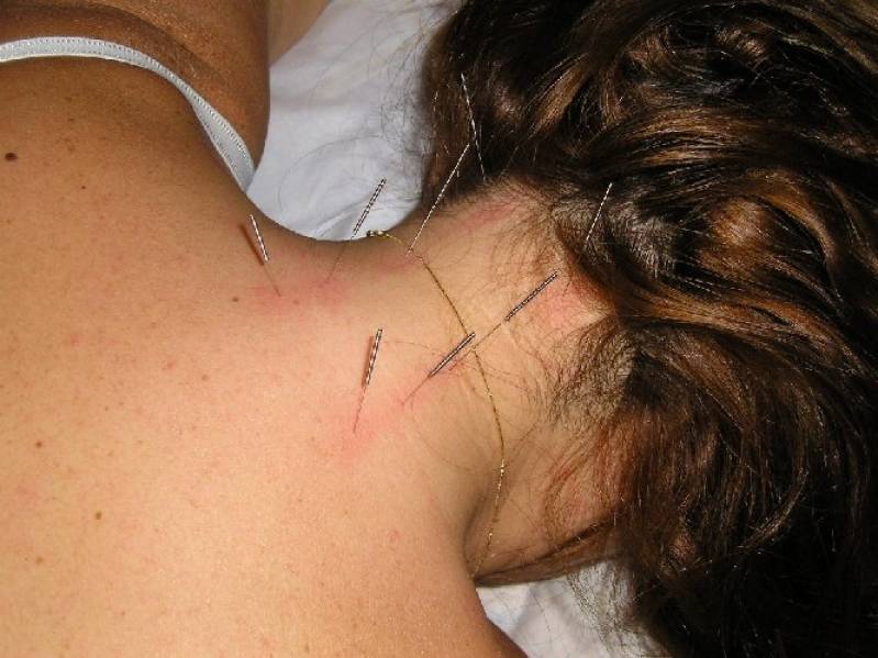 Onde Encontro Clínica de Acupuntura para Dor nas Costas Jardim Guedala - Clínica de Acupuntura para a Coluna Cervical