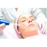 peeling de diamante para melasma